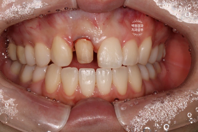 잇몸 성형과 치아미백 그리고 지르코니아 20대 앞니 크라운 치료. 치료과정/기간/비용. 관련 이미지 10