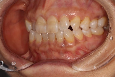 치아크랙 (금간 치아)의 찌릿한 통증 - 발치하지 않고 살려보기. 원인/진단/치료과정/비용/기간. 보존과전문의 치과. 관련 이미지 12