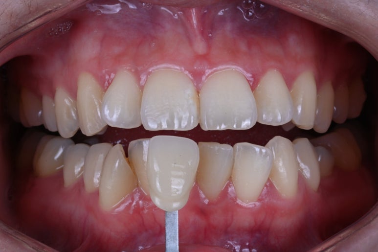 강남 치아미백 성지 레브치과. 가격/비용/부작용/전후사진. 관련 이미지 3