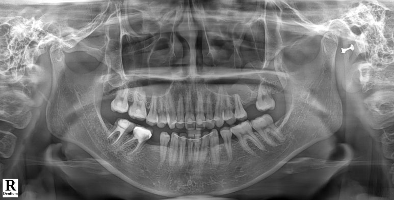 신사역 라미네이트. 결혼식 전 앞니 고민, 얇은 세라믹 레브네이트로 해결! 관련 이미지 3