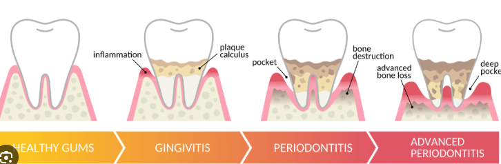 잇몸치료에 대한 모든 것. 치주과 전문의가 설명하는 치주염 치료 비용,과정, 통증, 방법 그리고 치과 실비보험. 관련 이미지 4