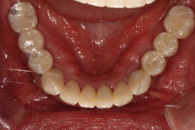 어금니 여러개가 없어요. 전체 임플란트와 앞니 크라운을 통한 완벽한 재건!! 치료과정/치료기간/비용/후기. 관련 이미지 31