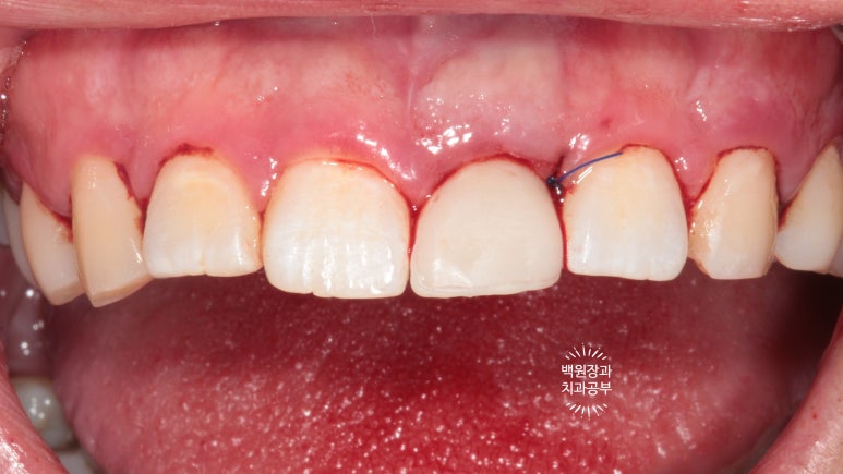 앞니 머리가 기둥째 부러졌어요. 발치 동시 뼈이식 오스템 BA 임플란트. 치료과정/치료기간/비용/후기. 압구정 치과. 관련 이미지 19