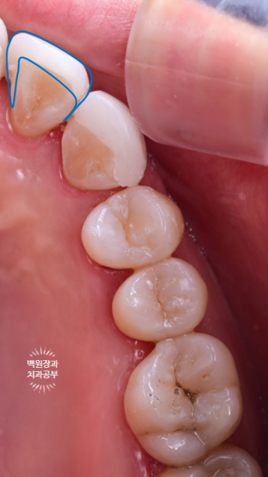 서울 신사역 [레브치과] 아래 앞니 치아 사이 틈 (블랙 트라이앵글) -  바이오클리어 치과에서 깔끔하게 해결. 관련 이미지 8