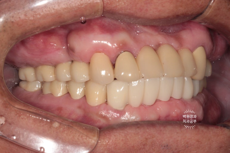 뿌리만 남은 앞니, 어금니가 없어 교합이 무너진 증례. 흡연자의 전체 오스템BA임플란트 재건증례. 치료과정/치료기간/비용/후기. 관련 이미지 21