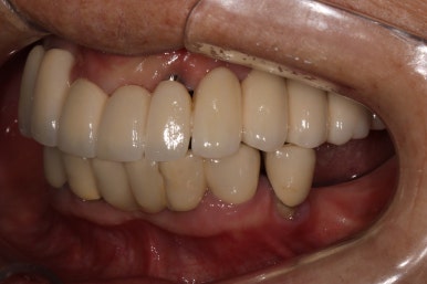 부분틀니를 오래써서 어금니가 아플 때, 아래턱 양쪽 어금니 임플란트 잘하는 강남임플란트치과 관련 이미지 5