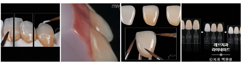 레브네이트 엑스퍼트 ; 유튜버가 선택한 앞니 라미네이트. 앞니 레진 벌어짐을 자연스러우면서 화사하게 바꿔봅시다. 신사역 치과. 치료후기/비용/가격. 관련 이미지 20