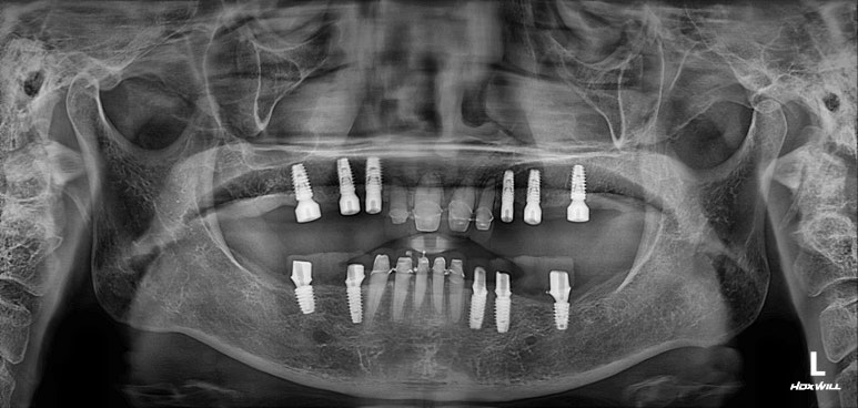 어금니 여러개가 없어요. 전체 임플란트와 앞니 크라운을 통한 완벽한 재건!! 치료과정/치료기간/비용/후기. 관련 이미지 22