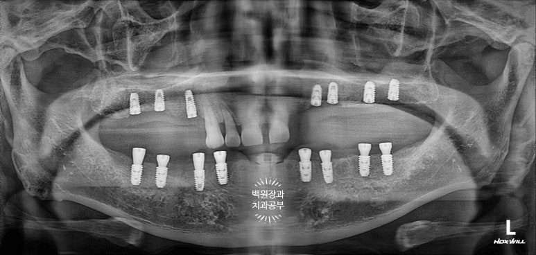 임플란트장인의 마음으로 8개월간 전체임플란트 완성. 치주과 전문의. 관련 이미지 16