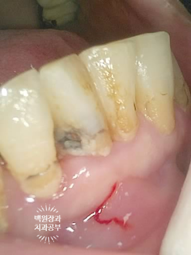 스트라우만 임플란트로 이뽑고 바로심는치과 - 믿고 사용하는 세계 1위 스위스 임플란트 회사. 관련 이미지 17