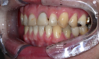 레브네이트 엑스퍼트 ; 유튜버가 선택한 앞니 라미네이트. 앞니 레진 벌어짐을 자연스러우면서 화사하게 바꿔봅시다. 신사역 치과. 치료후기/비용/가격. 관련 이미지 4