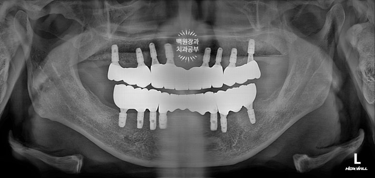 불편한 틀니를 아직도 쓰시나요? 전체 임플란트 치료비용/치료기간/치료과정. 관련 이미지 29