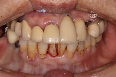 스트라우만 임플란트로 이뽑고 바로심는치과 - 믿고 사용하는 세계 1위 스위스 임플란트 회사. 관련 이미지 18