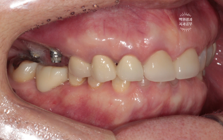 임플란트에서 고름이 나와요. 임플란트 주위염 그리고 재수술을 위한 준비. 치료과정/치료기간/비용/후기. 관련 이미지 12