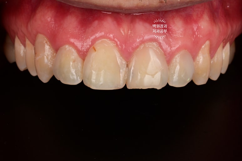 A European Patient at [Rev Dental Clinic] near Sinsa Station in Seoul Wanted Front Tooth Decay Treated with an EMAX All-Ceramic Crown. image 4