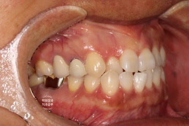 신경치료한 치아 부러짐! 뼈이식 하면서 임플란트 수술하는 과정/기간/비용. 관련 이미지 19