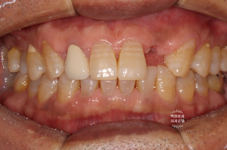 치아와 임플란트를 연결하면 치아가 망가집니다. 발치 동시 치조골 이식 후 임플란트. 치료과정/치료기간/비용/후기. 관련 이미지 2