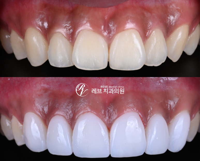 What About Laminates at Sinsa Station? Rev Dental Clinic’s Revnate. image 20