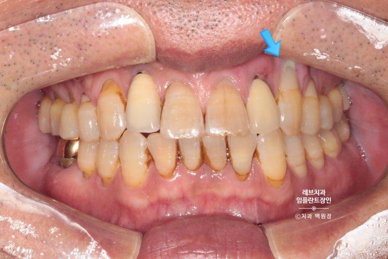 앞니 부러짐? 뽑고 바로 임플란트 + 뼈이식. 앞니 흔들림? 뽑고 1달 기다리고 임플란트 + 뼈이식. 신사역 치과 후기/비용/과정. 관련 이미지 12