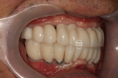 불편한 틀니를 아직도 쓰시나요? 전체 임플란트 치료비용/치료기간/치료과정. 관련 이미지 24