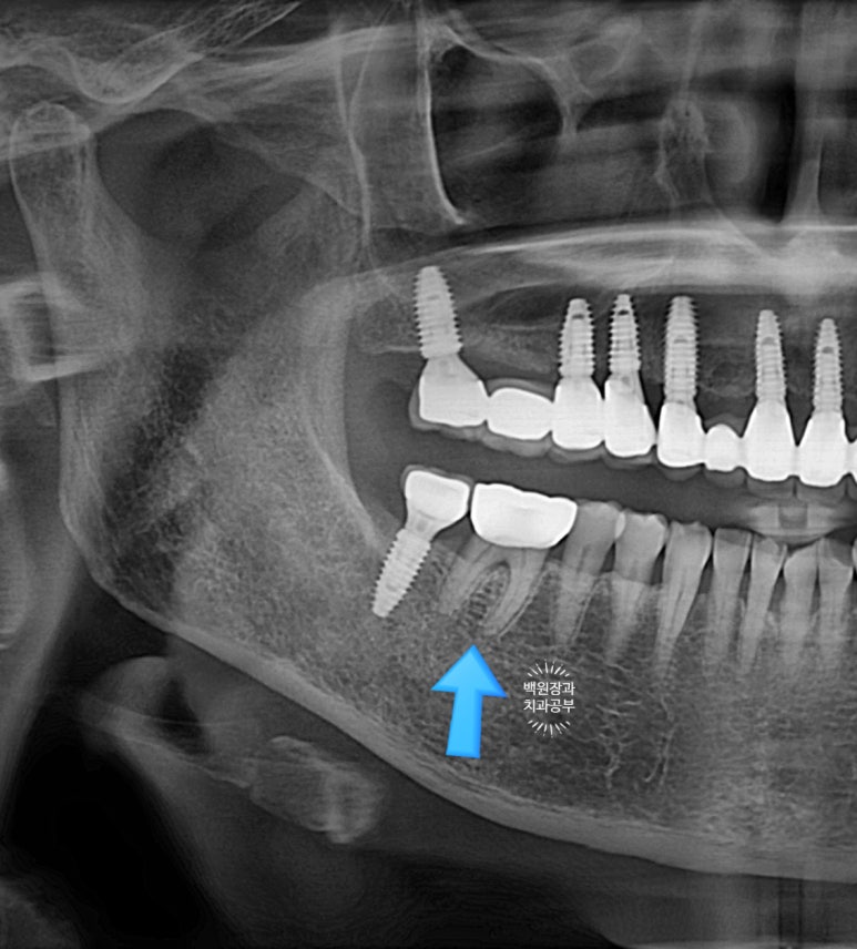 어금니 보철물이 떨어졌어요. 골드인레이 탈락 후 지르코니아 크라운으로 치료. 충치치료과정/치료기간/비용/후기. 관련 이미지 16