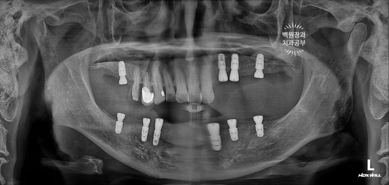 아래 어금니 임플란트 6개면 틀니를 안써도 됩니다.  치주염 전문 착한치과. 치료기간/임시치아과정/후기/비용. 관련 이미지 15