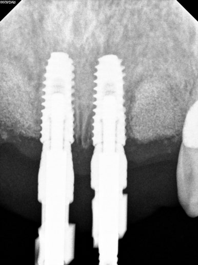 앞니가 풍치로 흔들거려요. 심한 치주염인데 임플란트 가능할까요? 치료과정/치료기간/비용/성공후기. 신금호역 치과 추천. 관련 이미지 28