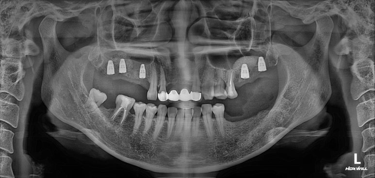 전세계 1위 스트라우만 임플란트를 사용한 어금니 기능회복과 앞니 지르코니아 크라운 증례. 관련 이미지 10