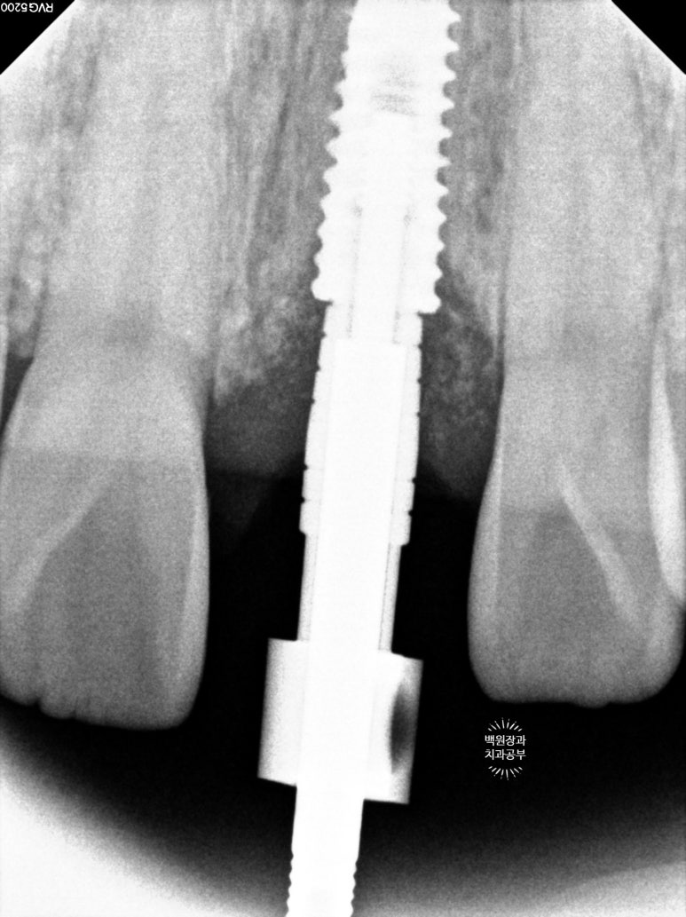 앞니 머리가 기둥째 부러졌어요. 발치 동시 뼈이식 오스템 BA 임플란트. 치료과정/치료기간/비용/후기. 압구정 치과. 관련 이미지 22