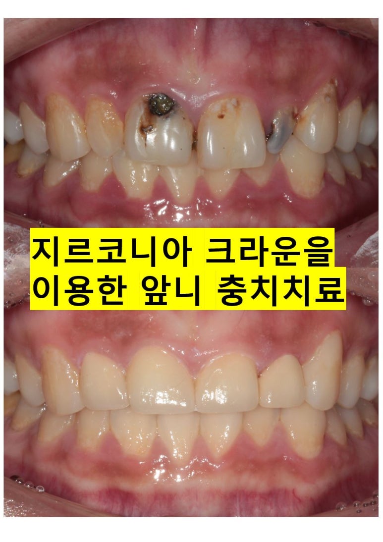 앞니에 잇몸염증과 충치가 심해요. 앞니 지르코니아 크라운 성공 후기. 치료과정/치료기간/비용/전후비교. 관련 이미지 1