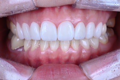 신사역 라미네이트. 결혼식 전 앞니 고민, 얇은 세라믹 레브네이트로 해결! 관련 이미지 27