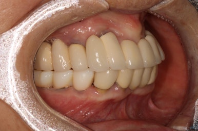 부분틀니를 오래써서 어금니가 아플 때, 아래턱 양쪽 어금니 임플란트 잘하는 강남임플란트치과 관련 이미지 19