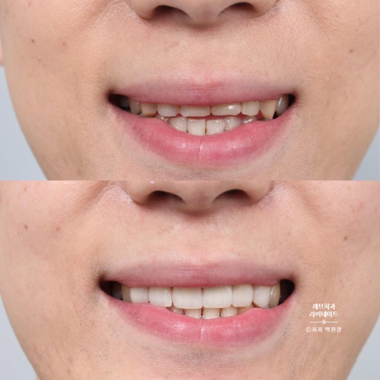 레브네이트 엑스퍼트 ; 유튜버가 선택한 앞니 라미네이트. 앞니 레진 벌어짐을 자연스러우면서 화사하게 바꿔봅시다. 신사역 치과. 치료후기/비용/가격. 관련 이미지 16