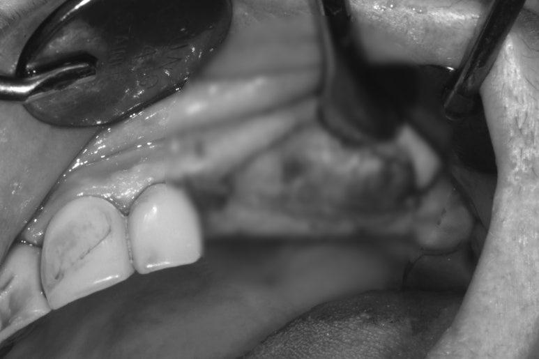 어금니 여러개가 없어요. 전체 임플란트와 앞니 크라운을 통한 완벽한 재건!! 치료과정/치료기간/비용/후기. 관련 이미지 23