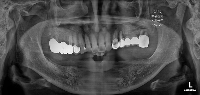 아래 어금니 임플란트 6개면 틀니를 안써도 됩니다.  치주염 전문 착한치과. 치료기간/임시치아과정/후기/비용. 관련 이미지 2