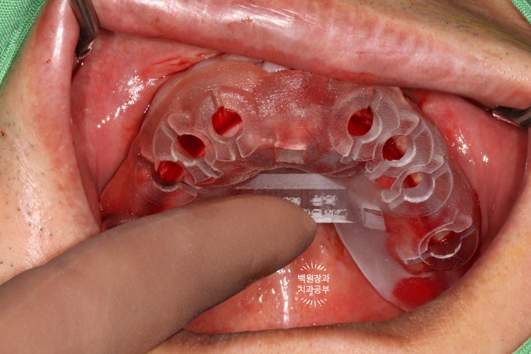 만성치주염으로 인해 아주 좁아진 잇몸뼈에 광범위한 뼈이식 + 전체임플란트. 신사 레브치과. 관련 이미지 20