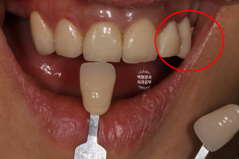 부분틀니 대신 어금니 임플란트를 만들어드립니다. 40대 어금니 상악동 뼈이식 임플란트. 치료기간/비용/과정. 관련 이미지 15