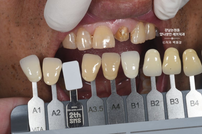 강남논현동치과 60대 치아부러짐 - 신경치료하고 기둥심고 앞니 크라운 잘하는곳! 가격/과정/후기/부작용. 관련 이미지 8