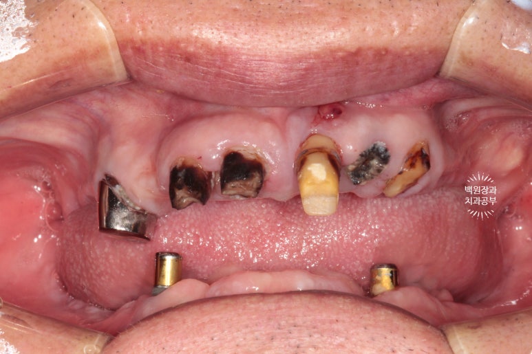 임플란트틀니 - 오버덴쳐. 오스템BA임플란트 이용한 최고의 가성비 치료. 치료과정/치료기간/비용/후기. 관련 이미지 2