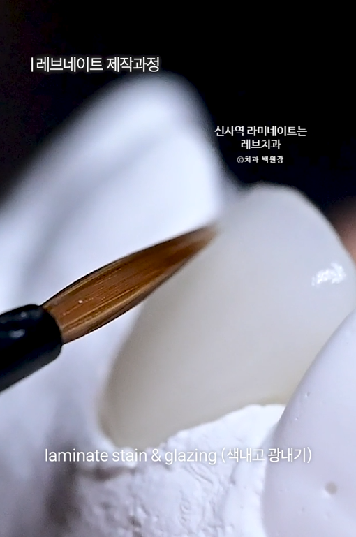 신사역 라미네이트, 잘하는 치과의 치료과정과 재료.설명.비용.후기. 관련 이미지 6