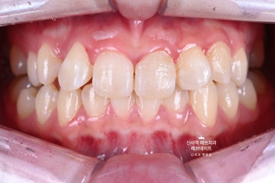 신사역 치과. 아나운서 면접 전 앞니 벌어진 공간을 라미네이트로만 해결할 수 있었던 사연.. 관련 이미지 30