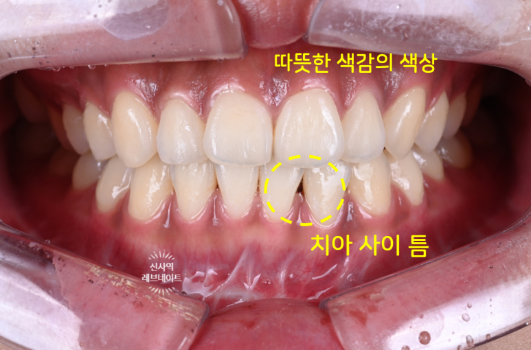 What About Laminates at Sinsa Station? Rev Dental Clinic’s Revnate. image 3