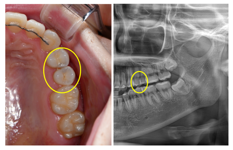 옆면 어금니 충치 하루만에 가능한 논현동 치과. 치아미백 가격 후기. 관련 이미지 7