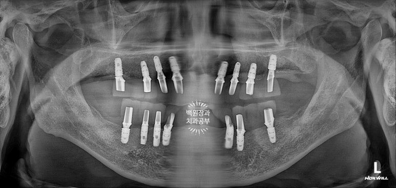불편한 틀니를 아직도 쓰시나요? 전체 임플란트 치료비용/치료기간/치료과정. 관련 이미지 16