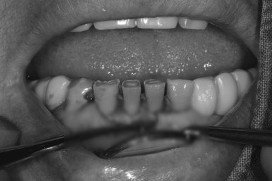 어금니 여러개가 없어요. 전체 임플란트와 앞니 크라운을 통한 완벽한 재건!! 치료과정/치료기간/비용/후기. 관련 이미지 16