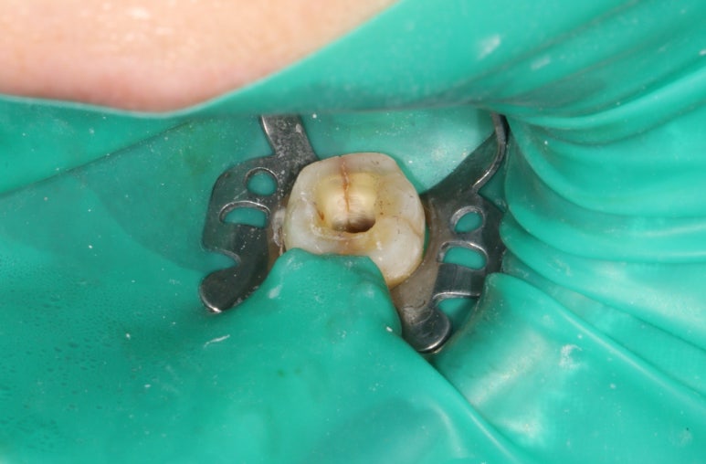 치아크랙 (금간 치아)의 찌릿한 통증 - 발치하지 않고 살려보기. 원인/진단/치료과정/비용/기간. 보존과전문의 치과. 관련 이미지 9