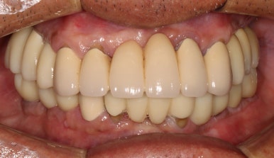 잇몸 염증 고름이 심했던 부위 - 만성치주염 진단하고 임플란트로 깔끔하게 치료! 신사역 치과 관련 이미지 27