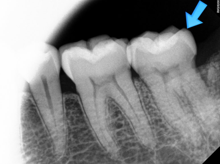 치아크랙 (금간 치아)의 찌릿한 통증 - 발치하지 않고 살려보기. 원인/진단/치료과정/비용/기간. 보존과전문의 치과. 관련 이미지 8