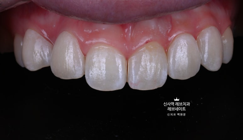 신사역 치과. 아나운서 면접 전 앞니 벌어진 공간을 라미네이트로만 해결할 수 있었던 사연.. 관련 이미지 22