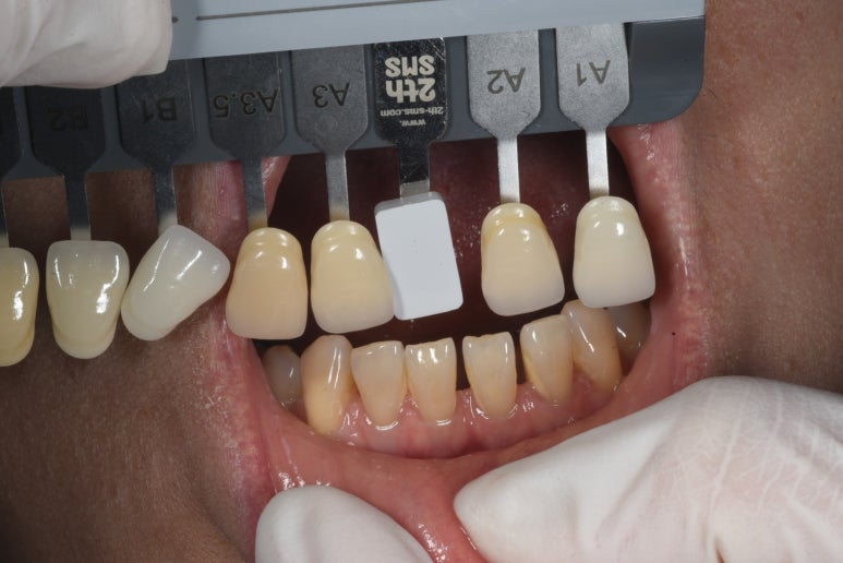 레브네이트 엑스퍼트 - 앞니 무삭제 라미네이트. 40대 벌어진 앞니에 변색된 레진은 이제 그만! 압구정 치과 추천 전후/비용. 관련 이미지 10